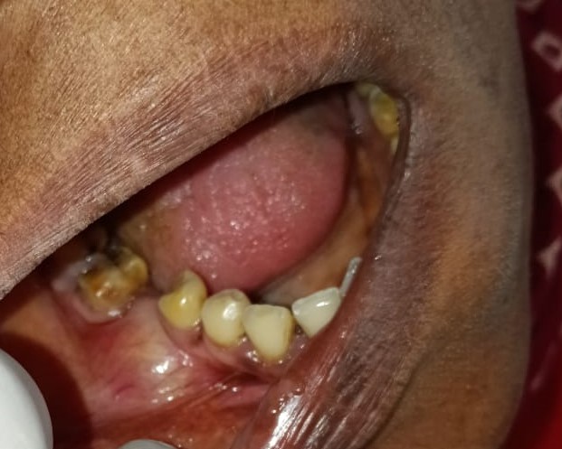 Jaw Cyst and Tumors